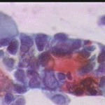 Αδενικά κύτταρα με διογκωμένους αρραιοχρωματικούς πυρηνες και διάλυση δομής χρωματίνης. Οξεόφιλα επιφ. κύτταρα. Επίχρισμα του 2004